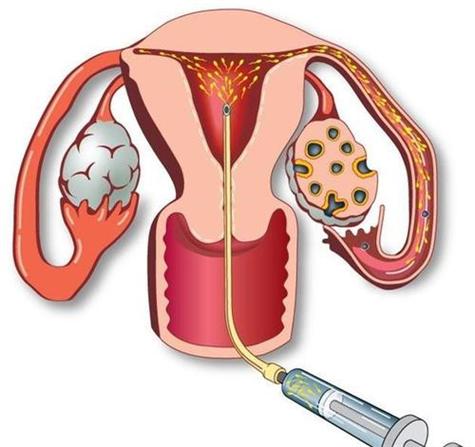 供卵试管代怀产子过程【供卵试管代怀产子：一场奇迹的孕育之旅】